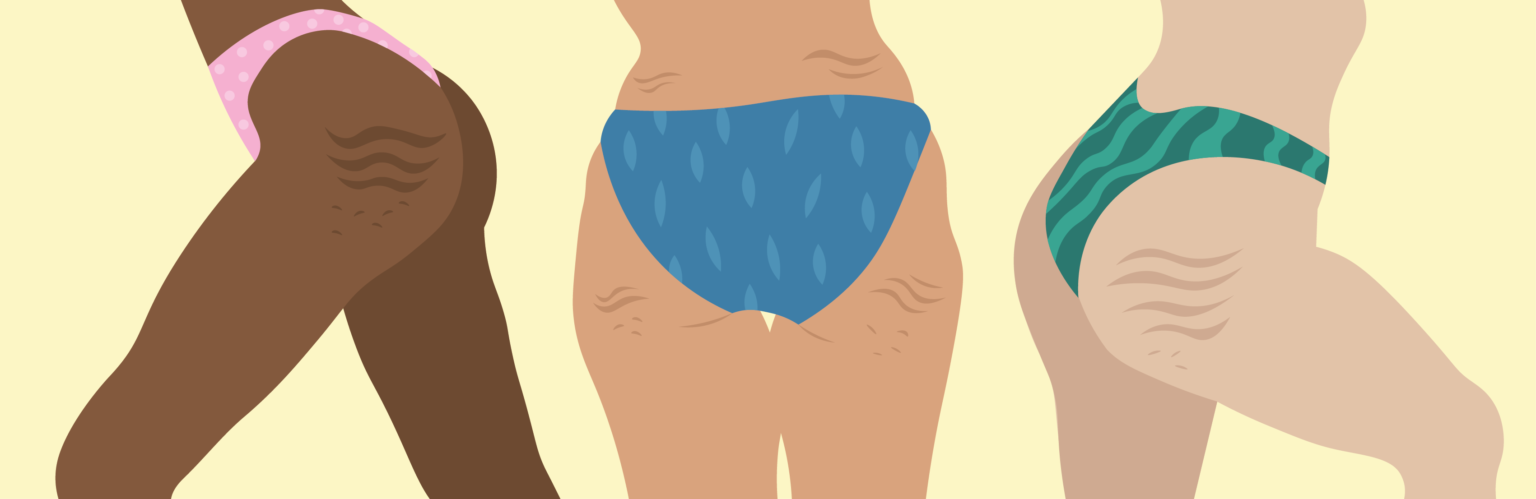 Illustratie van vrouwen met cellulite